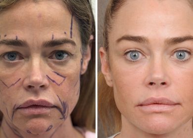 Denise Richards’ Raw Facelift Before-and-After Photos Are the Transparency We Need