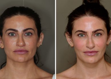 I Tried Facial Fat Grafting—Here's How I Feel About My Results 2 Years Later