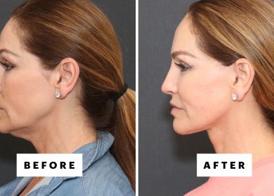 The Trending Procedure That Can Restore Your 25-Year-Old Jawline—With Before and After Photos