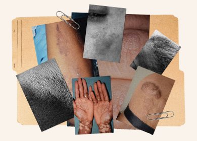 11 Common Skin Conditions on Dark Skin and How to Treat Them